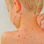 Le psoriasis comme lhypertension